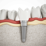 bigstock-Dental-Implant-Detail-116727992