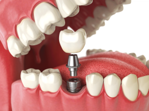 full mouth dental implants in tampa